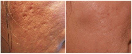 acne scar treatments
